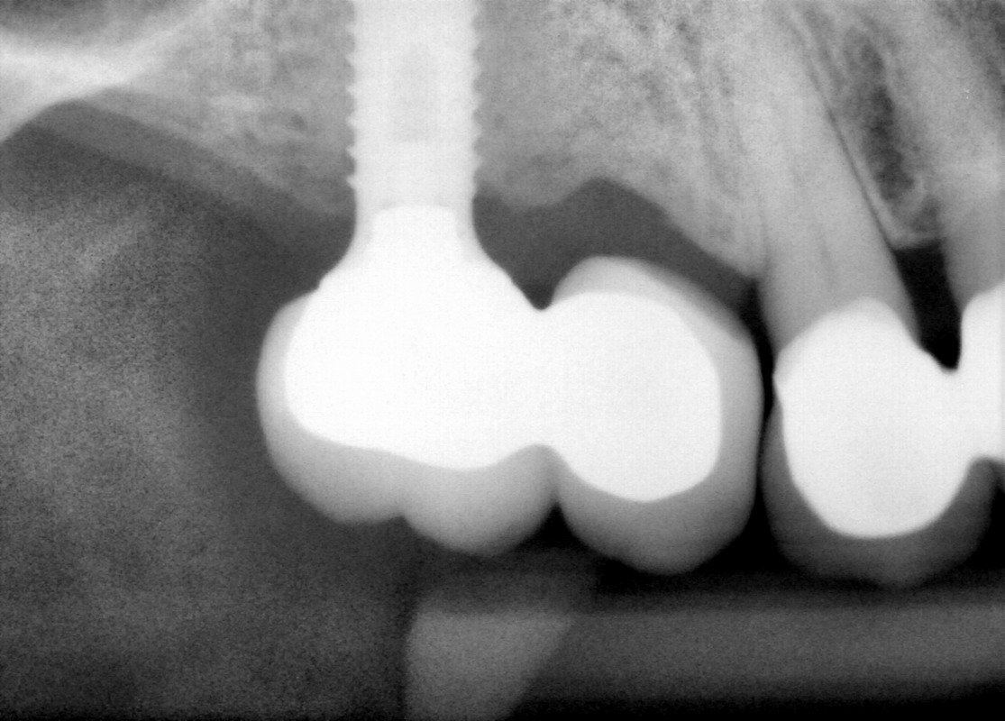 Blue Sky Bio BIO One Stage (Straumann One Stage Compatible) Dental